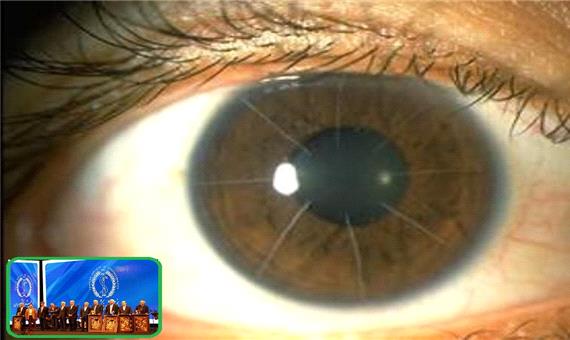 قرمزی و سوزش چشم، علت اصلی مراجعه بیماران به متخصص قرنیه است